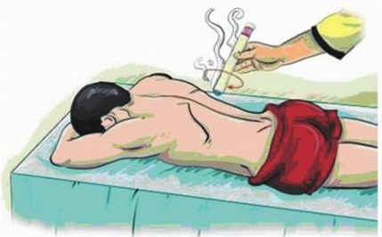 艾灸疗法,风湿性关节炎
