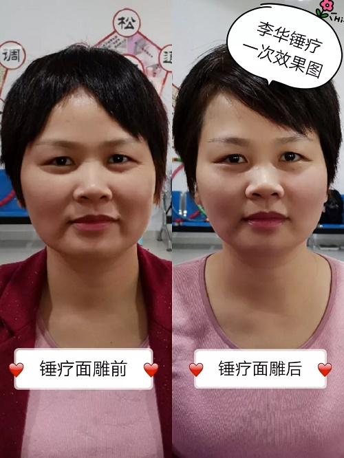 锤正疗法,锤正疗法工具,锤正疗法培训
