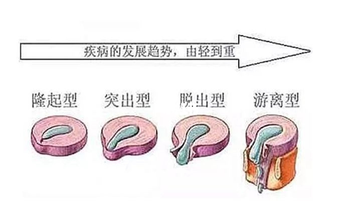 腰椎间盘突出,锤疗,锤正疗法