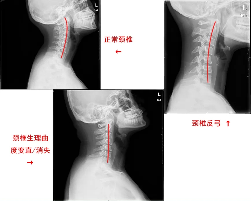 锤疗,锤击疗法,槌凿疗法,锤正疗法